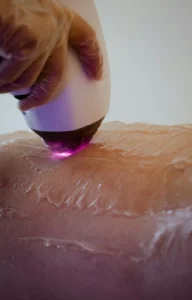Aplicación de láser SHR en zonas delicadas del cuerpo